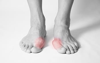 Hallux Valgus