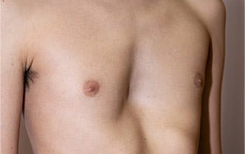Pectus Excavatum (Təsisçinin Sinəsi)