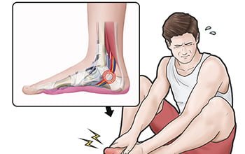 Tarsal Tunel Sindromu